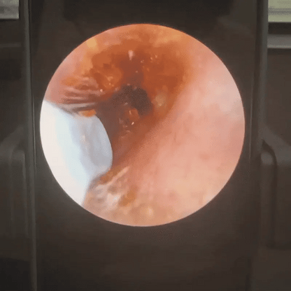 EarVision Pro – Limpiador de Oídos con Cámara HD